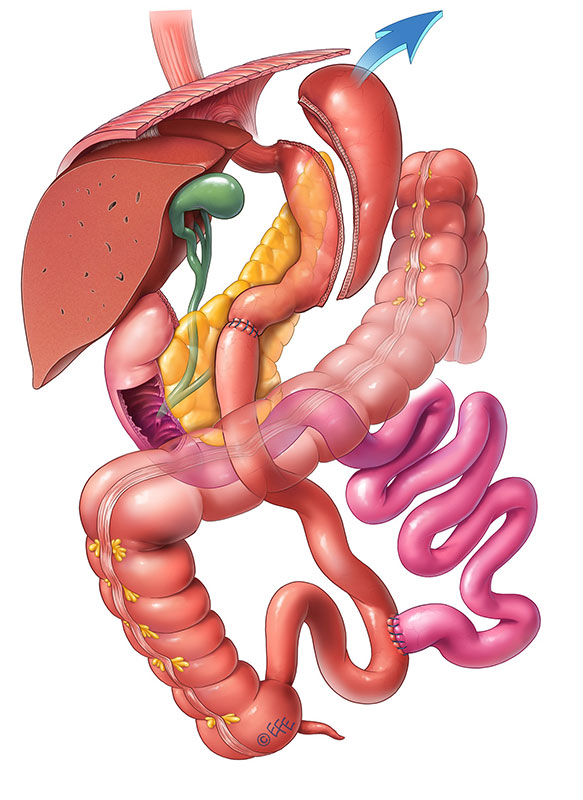 Biliopankreatik Diversiyon anatomik görünümü.