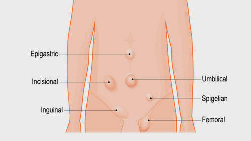 Vücudumuzda Nerelerde Fıtık Görülür?