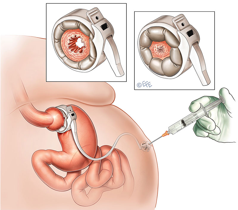 Mide Bandı (mide kelepçesi)n anatomik görünümü.