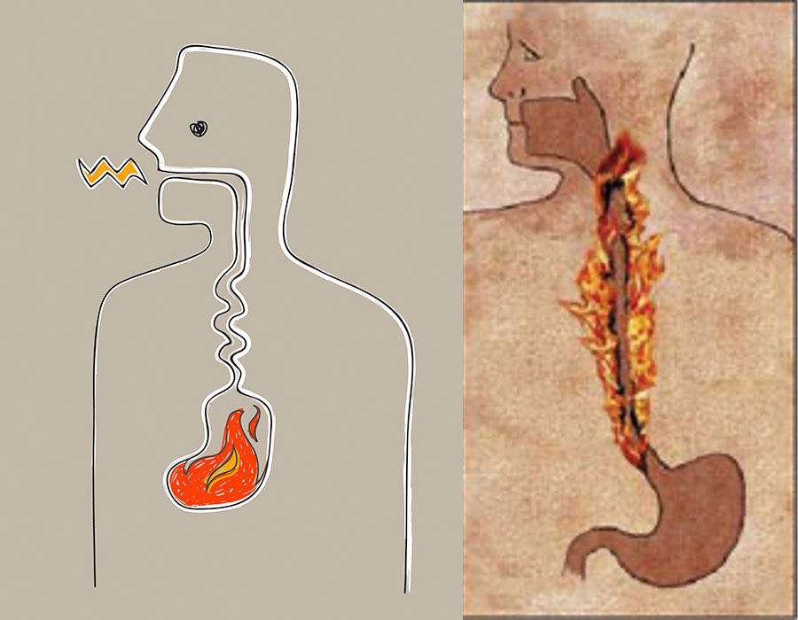 Gastroözofageal Reflü Hastalığını Tanımı