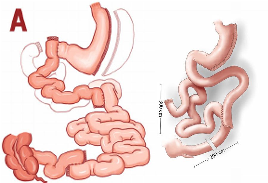 İleal interpozisyon (Şeker ameliyatı) anatomik görünüm.