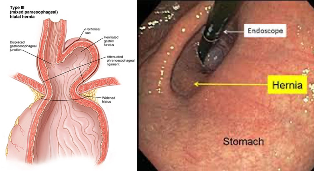 Tip 3 Mide Fıtığı