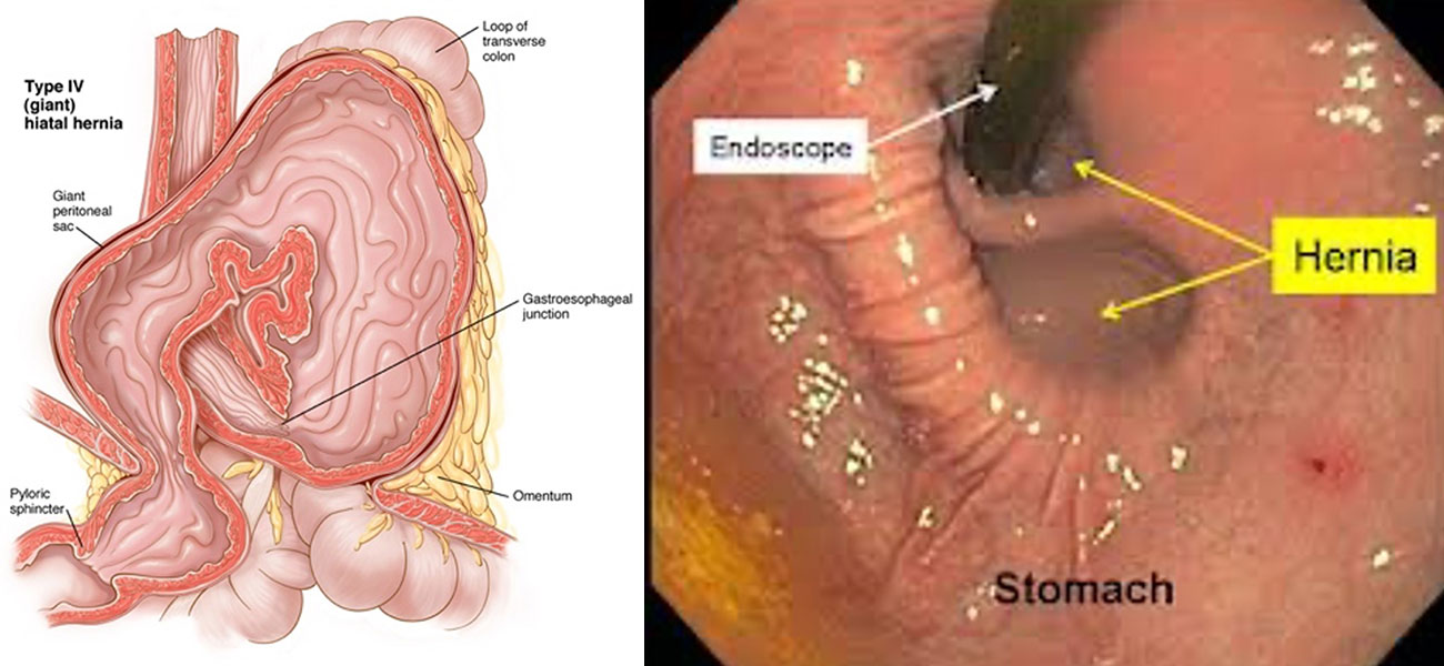 Tip 4 Mide Fıtığı