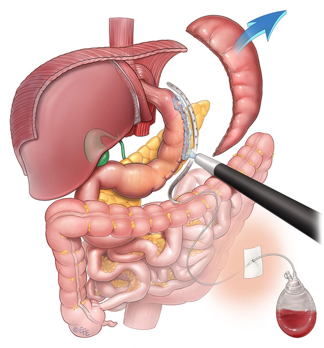 Sleeve gastrektomi veya mide küçültme ameliyatı anatomik görünümü