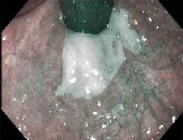 Yüksek Çözünürlük ve NBI?