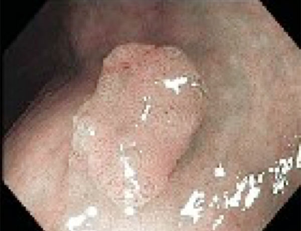 Yüksek Çözünürlük ve NBI?