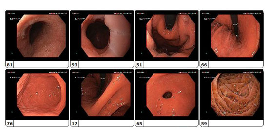 Endoskopi Raporu Ne Diyor? Üst Gastrointestinal Endoskopi Bulguları ve Terim Açıklamaları